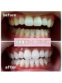 ビーホワイト 名古屋金山店(BE WHITE)/ ホワイトニング★フェイシャル