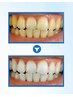 【回数券】【美白歯】セルフホワイトニング30分　45000円12回券　1回/3750円
