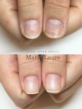 マリーロール 梅田店(Marie Laure)/深爪矯正/自爪育成/自爪風