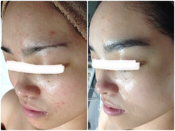 ルノン(LUNON)/ツルツルに♪