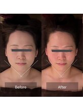 アン シェリー(un Cherie)/お顔のむくみがスッキリ小顔！