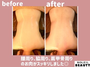 ソレイユビューティー 愛知大学前(SOLEIL BEAUTY)/スッキリ背中♪