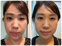 ヒメミ(Himemi)/インセルダムスキンケア