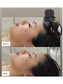 ミャオ(Meow!)/チタニウムリフト×レモンボトル