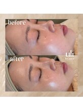 ウリ(uli beauty)/比較写真