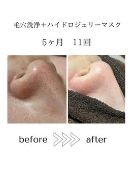 サロン エイトミー(salon 83)/【毛穴洗浄】before→after