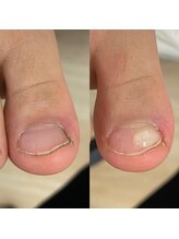 スマートリフト 五反田 大崎店(SMART LIFT)/深爪改善施術【大崎/五反田】