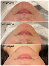 ハーシークレット(Her secret)/ハーブピーリングDT有・経過