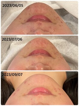 ハーシークレット(Her secret)/ハーブピーリングDT有・経過