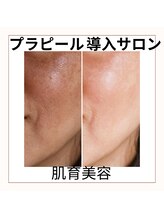 カモン(KAMON)/【肌育革命】美肌ピーリング体験