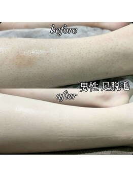 セルフライン(SELF LINE)/足脱毛