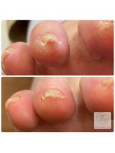 サロン アンド ルクス(Salon & Lux)/巻き爪ケア