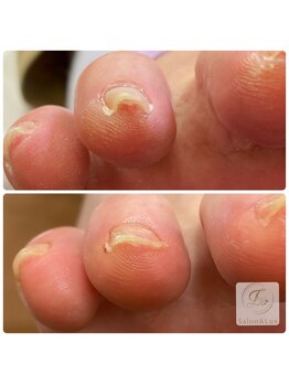サロン アンド ルクス(Salon & Lux)/巻き爪ケア