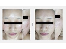 スイ 昭島店(Sui)/ホワイトスノーピール/シミ/美白