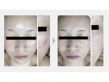 スイ 昭島店(Sui)/ホワイトスノーピール/シミ/美白