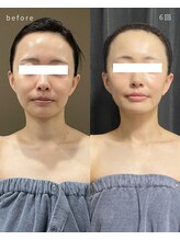 レクシア(LEXIA)/小顔ケア症例｜PRO LIFT