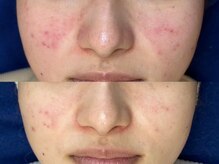 ロイ 初生店(LOI)/ハーブ×プラズマ