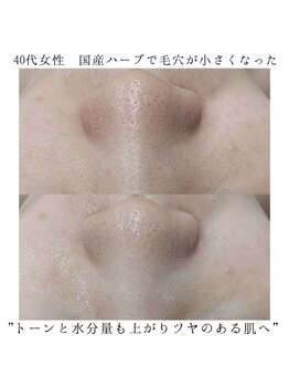 ヴェルシック(Belchic)/毛穴を小さくできる