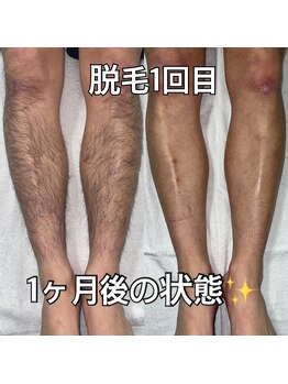 リエル(RIEL)/【部分脱毛】