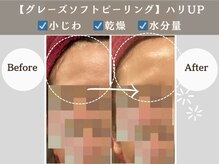 アンジュ(ANGE)/グレーズソフトピーリング症例