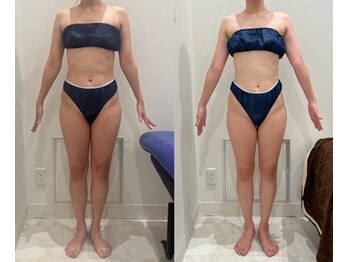 エレン(Elen)/最強ダイエットデトックスコース