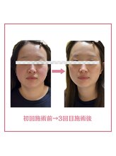 ラシー(la she)/顔のむくみが気になる20代