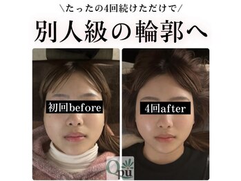 キュープ 高崎店(Qpu)の写真/【小顔頭蓋骨矯正＋オイルケア￥9,900→￥8,400】高濃度酸素オイルでよりスッキリ！より小顔に！