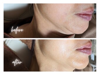 エボルブ 四条烏丸店(EVOLVE)/リフトアップ&肌質改善!