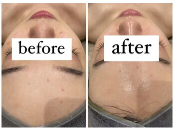 サラ(Sarah)/ハーブピーリングREVI