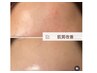 【30代の肌が更によみがえる☆】ステップUP！ハーブピーリング＆毛穴洗浄