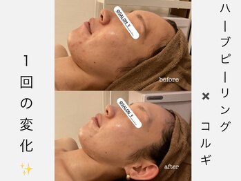 サロンワイアネシス(Salon y ANESIS)/ハーブピーリング×コルギ　