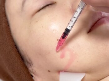 ミセル(MISEL2nd)の写真/【たるみ・二重あご徹底アプローチ!】半永久的小顔造形★プラズマフェイシャル×脂肪分解美容液導入*