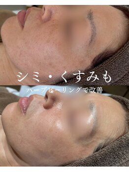 インテリウス(INteRius.)/シミ・くすみケア