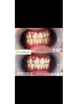 ルブラン 奈良店(Le Blanc)/男性の方のホワイトニングも
