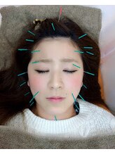 オハナ接骨院 鍼灸院 初芝駅前院(Ohana接骨院 鍼灸院)/美容鍼〈コラーゲン誘発鍼〉