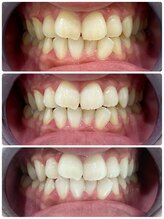 エクシアホワイトニング 日本橋店/3ヶ月経過！