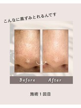 カシェット(Cachette.)/毛穴洗浄フェイシャル1回目