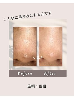 カシェット(Cachette.)/毛穴洗浄フェイシャル1回目