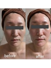 リルーチェ 倉敷(Riluce)/ヒト幹細胞導入1回の施術