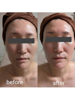 リルーチェ 倉敷(Riluce)/ヒト幹細胞導入1回の施術