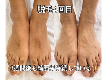 リエル(RIEL)/【部分脱毛】