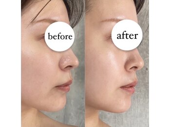 ブランカ(BLANCA)/エクソソーム水光導入