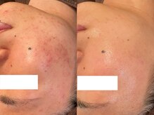 リラ(Lilas)/ハーブピーリング