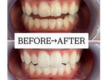 ホワイトニングサロン 宝塚/Before&After美白ホワイトニング