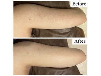 ベル 恵比寿(Belle)/REVI陶肌ハーブピーリング