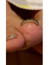 フットケアサロン ラビフット(Rabbi foot)/ツメフラの効果