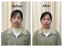まごころ整骨院/美容鍼Before&After(１回施術）