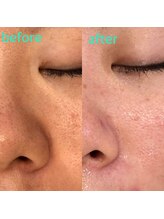 レナンセラ バイ カトレアグループ(Renanthera by カトレアGroup)/毛穴洗浄に自信あり！