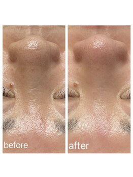 A&A 小山VAL店/毛穴洗浄