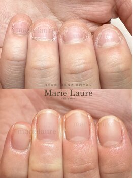 マリーロール 淀屋橋本店(Marie Laure)/自爪育成/深爪矯正/ネイルケア